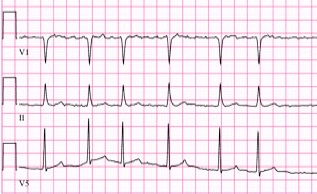 A New Treatment For Atrial Fibrillation in the Elderly?: The (IR)relevance of Clincial Resarch to Geriatric Populations