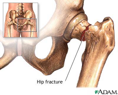 Hip Fracture: “A Quintessential Geriatric Illness”