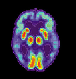 The new brain scan for Alzheimer’s: what’s early certainty worth?