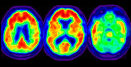 Should My Patient Get an Amyloid PET Scan for the Diagnosis of Alzheimers?