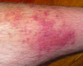 Is Prevention Possible? Antibiotic Prophylaxis for Recurrent Lower Extremity Cellulitis